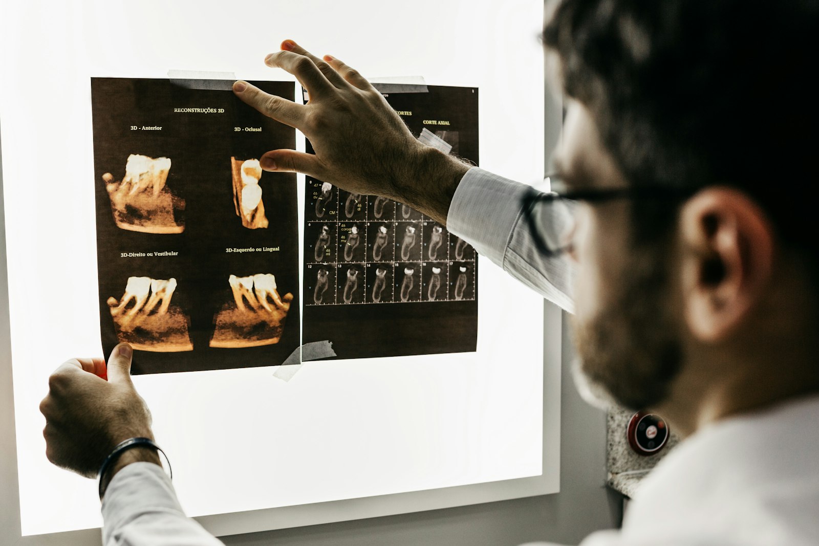 Protese em Zirconia Sobre Implante