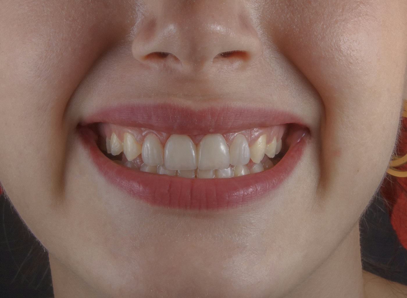 Registro clinico do sorriso antes do tratamento reabilitador